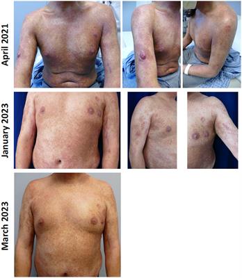 Expert opinions and clinical experiences with chlormethine gel as maintenance treatment for patients with mycosis fungoides